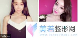 郑大二附院刘月丽自体脂肪隆胸案例果及价格
