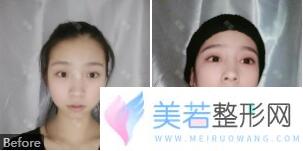 深圳美莱医院眼部整形案例果图