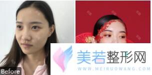 深圳美莱医院鼻部整形案例果图