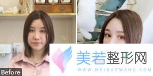 深圳非凡医院鼻部整形案例果图