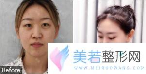 深圳阳光医院眼部整形案例果图