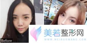 深圳阳光医院鼻部整形案例果图