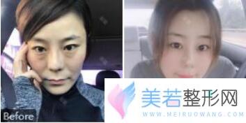 深圳北大医院李天石眼部整形案例果图
