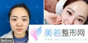 深圳北大医院崔永言双眼皮案例果图