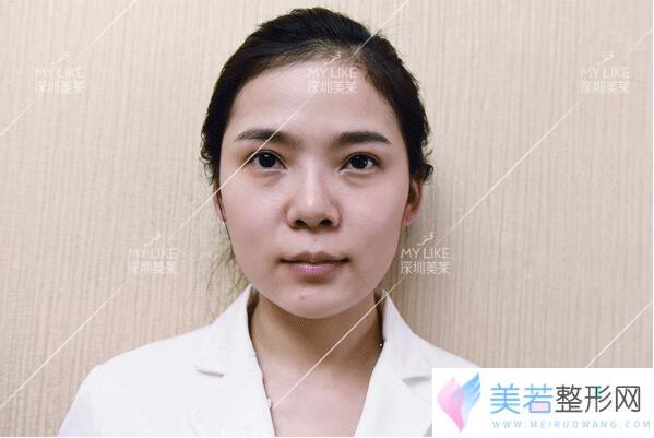 深圳美莱梁晓健鼻子做得怎样