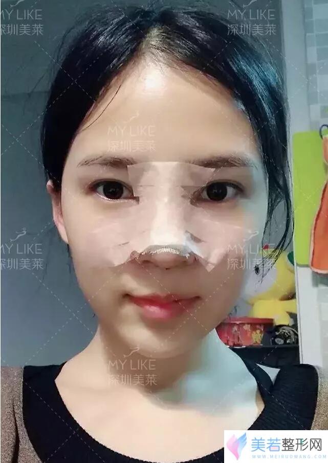 深圳美莱梁晓健鼻整形案例果图