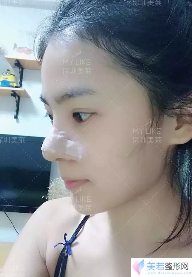 深圳美莱梁晓健达拉斯定制塑鼻