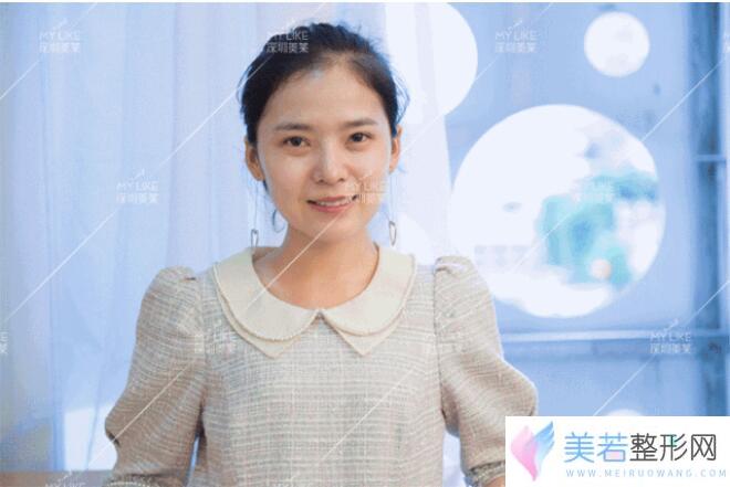 深圳美莱梁晓健达拉斯定制塑鼻恢复过程