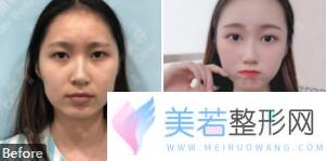 深圳金丽张德清自体脂肪填充案例果图