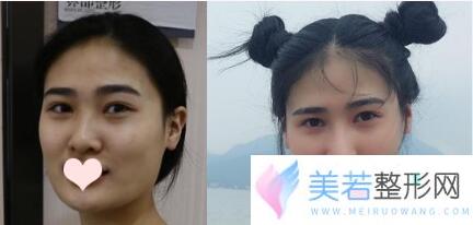 深圳阳光罗志敏肋软骨隆鼻案例果图