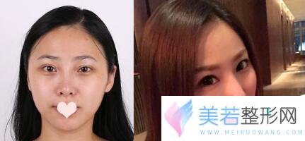 深圳阳光罗志敏鼻部手术案例果图