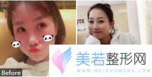 深圳金丽朱冠峰鼻整形案例果图