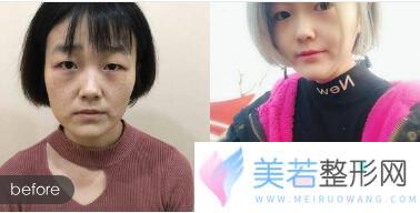 深圳非凡激光美肤祛斑前后对比图