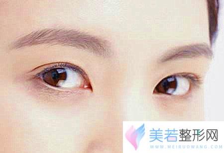 武汉协和医院割双眼皮好吗？