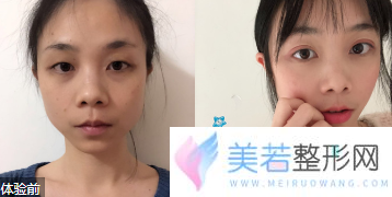 武汉协和医院整形科双眼皮案例展示