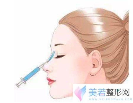 玻尿酸