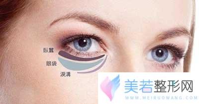 如何改良臃肿眼袋？去眼袋的三个方法