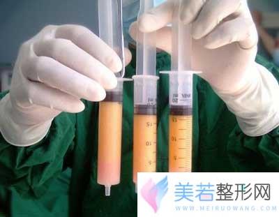 自体脂肪丰臀果怎么样？让臀形更加丰满挺翘!