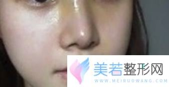 上海九院李圣利做自体脂肪隆鼻有没有失败案例？坐诊时间什么时候