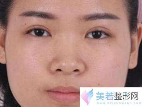 上海九院李青峰做鼻部手术门诊排队时间？多少钱？价格表