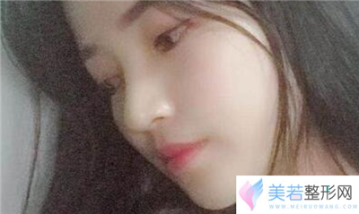 上海九院整复科李青峰做假体隆鼻怎么样_门诊排队挂号时间_案例果