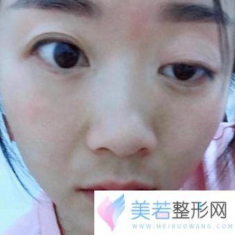 双眼皮做失败修复术前
