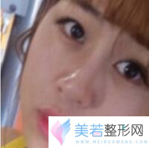 杭州连天美做鼻子怎么样？价格多少钱？曝光鼻部价格表
