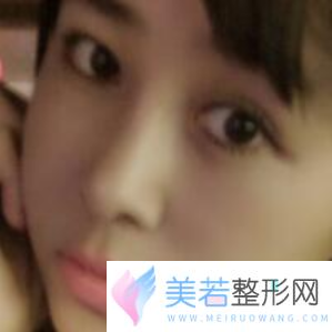 杭州连天美做鼻子怎么样？价格多少钱？曝光鼻部价格表
