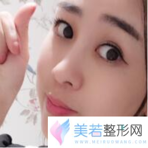 杭州连天美做鼻子怎么样？价格多少钱？曝光鼻部价格表