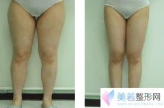 南方燕岭整形医院大腿吸脂多少钱