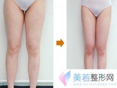 福州鼓楼医院整形医院大腿吸脂多少钱