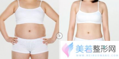 南京奇致整形医院腹部吸脂多少钱