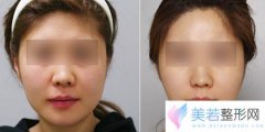 济南伊美尔整形医院注射注射瘦脸价格是多少