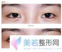山东中医药大学整形医院双眼皮手术价格是多少