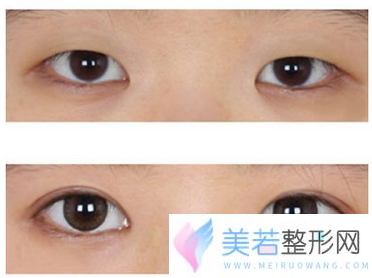 天津开外眼角手术的价格大概是多少？