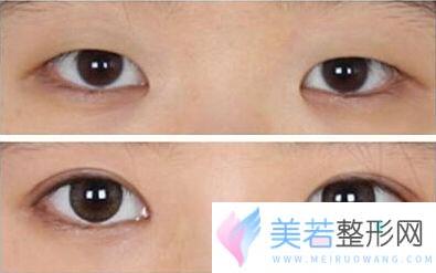 杭州割双眼皮一般多少钱