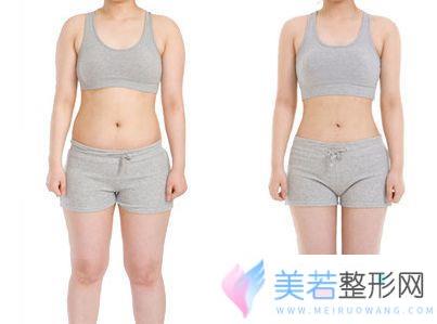 佛山吸脂减肥价格一览表