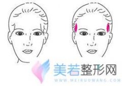 中山自体脂肪丰太阳穴多少钱