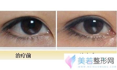 开眼角手术价格表，开眼角手术前后对比图