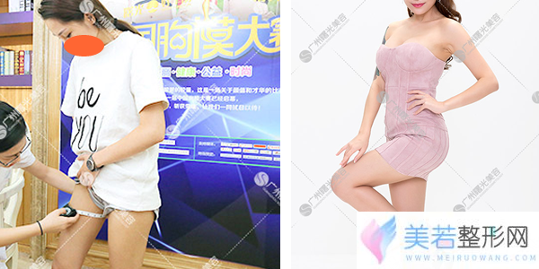 广州曙光万友望主任冰雕溶脂瘦大腿果对比图