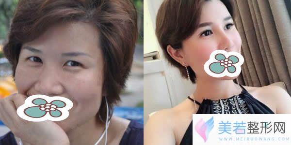 深圳格美整形黄印资院长小切口提升真人案例果