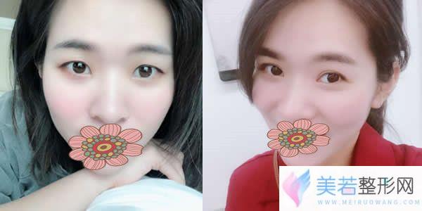 肇庆华美苏畅院长切开双眼皮+开眼角前后对比图