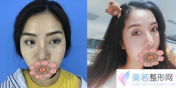 肇庆华美陈英华医生自体脂肪填充全脸真人案例果