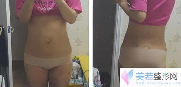 腰腹部吸脂第15天双腿粗细一致没有大小不一