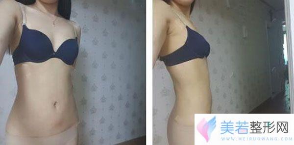 大腿吸脂一个月脂肪已经稳定