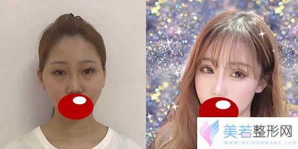 长沙华韩华美余春国主任做自体脂肪填充全脸真人案例果