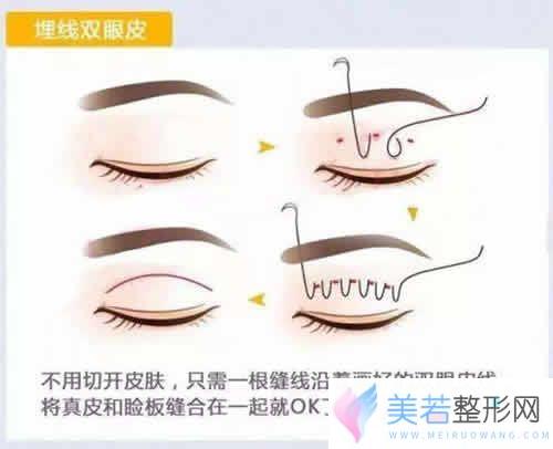 埋线双眼皮过程图解