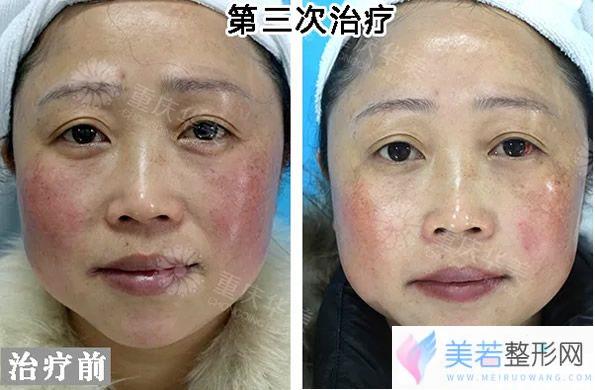 第三次激光祛斑果