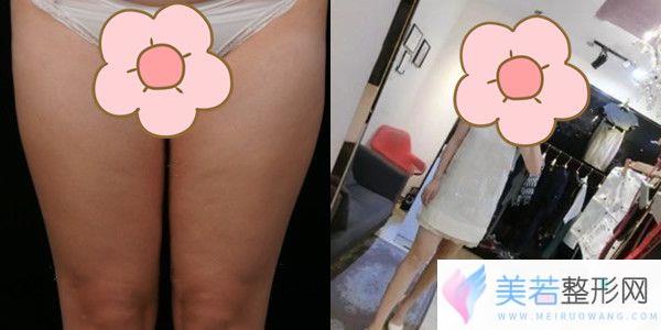 上海薇琳孙荣医生为我吸脂瘦腿前后对比照片