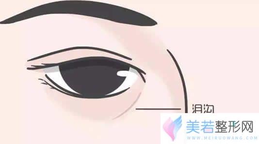 泪沟填充手术价格说明